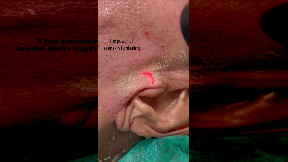Laser Skin Tightening